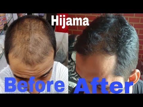 Hair fall Baldness Ganjapan(बालों का टूटना) treatment by hijama cupping  therapy 7017194019 دیدئو dideo
